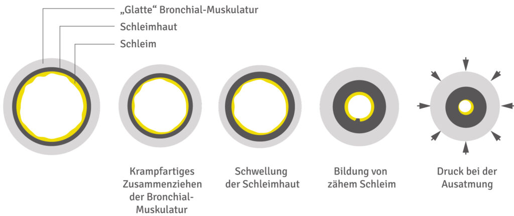 Verlauf eines allergischen Anfalls